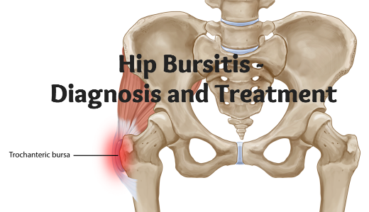 Hip Bursitis – Diagnosis and Treatment